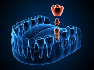 3d illustration of a dental implant abutment and crown in a jawbone cross section