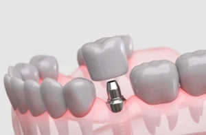 anatomical diagram showing the difference between a healthy tooth and a dental implant