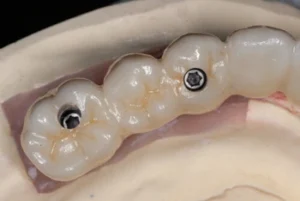 diagram-of-an-implant-retained-bridge for multiple missing teeth