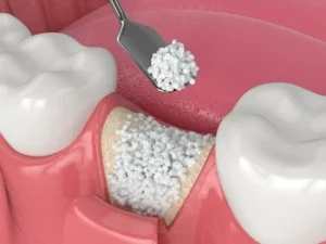 during dental bone graft treatment