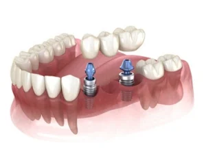 implant supported bridge illustration