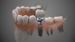 result of a molar tooth implant installation after the surgery