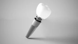 dental implant illustration with parts