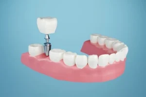 implant molar tooth illustration