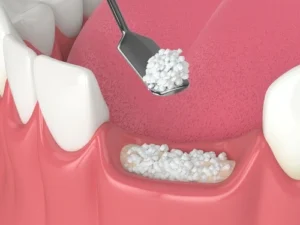 dental bone graft procedure